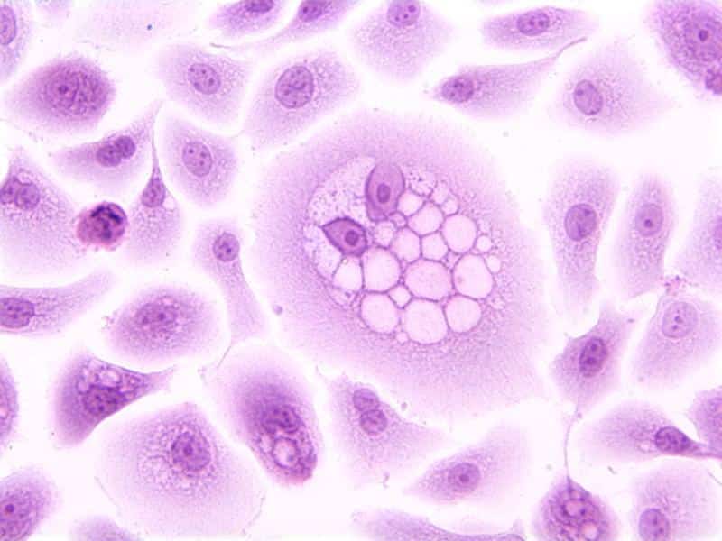 Fig 3. Un regalo inesperado: Virus del Papiloma Humano